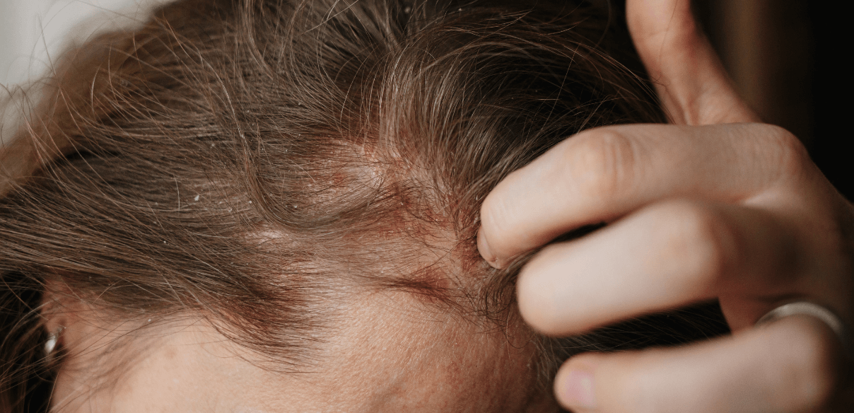 Dermatite séborrhéique et pellicules grasses : Comment en venir à bout ?